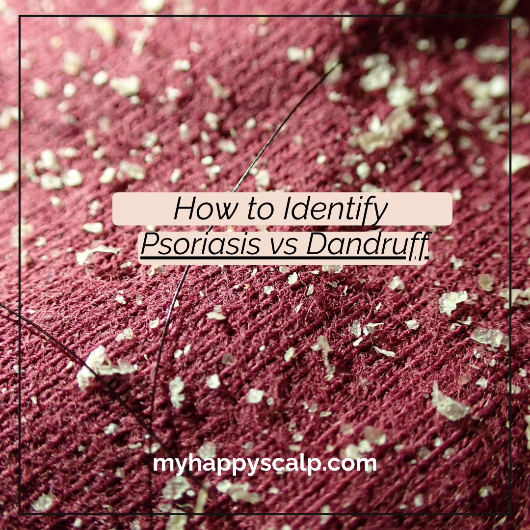 How to Identify the Difference Between Scalp Psoriasis and Dandruff