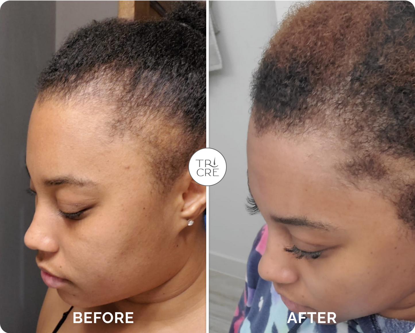 Derma Stamp + Regrowth Bundle