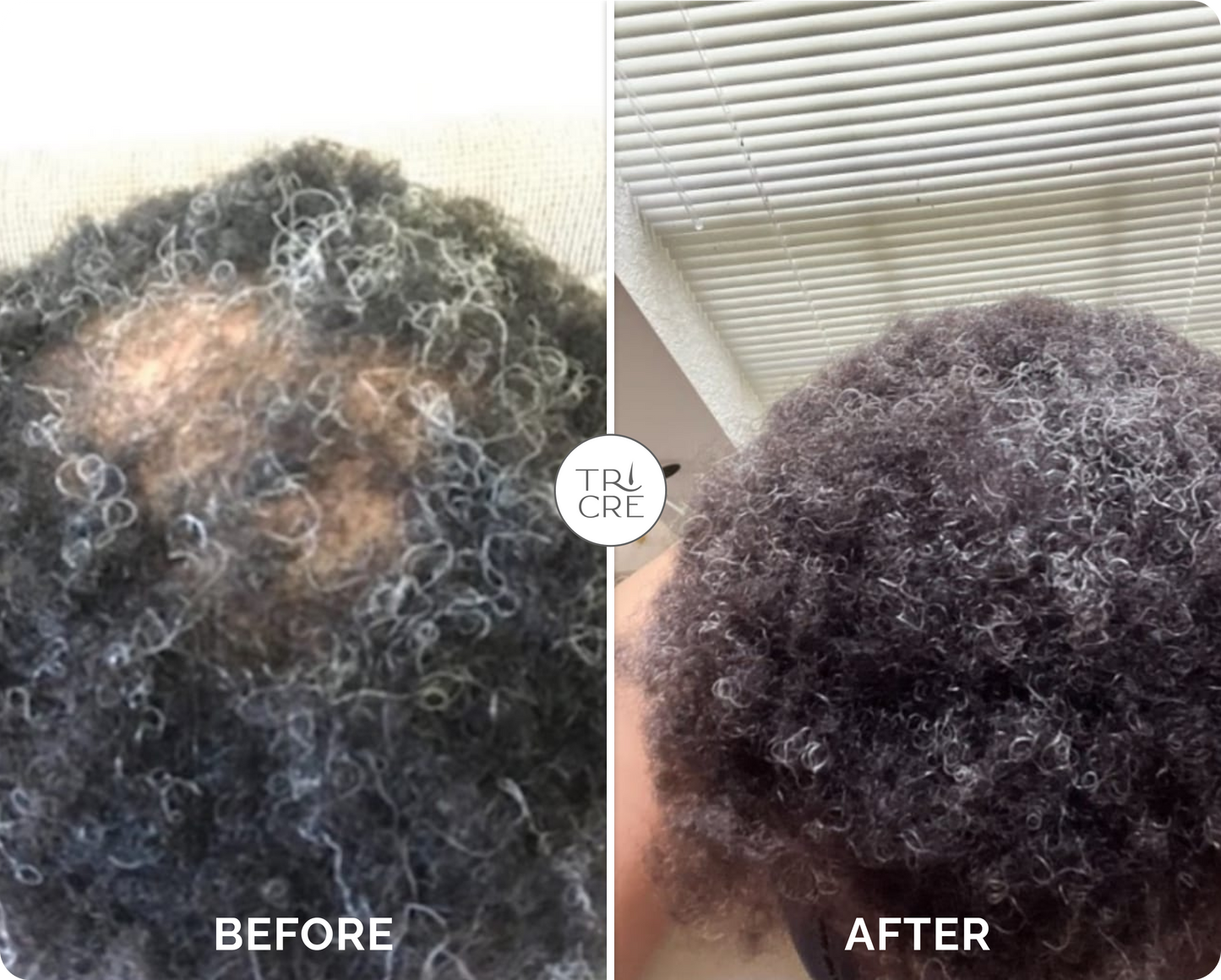 Derma Stamp + Regrowth Bundle